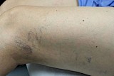 Before varicose vein treatment