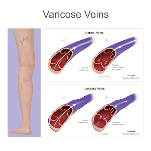 do varicose veins grow back do collapsed veins come back