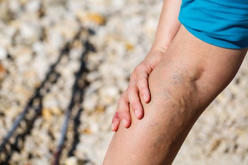 leg pain from varicose veins swelling inflammation leg cramps men