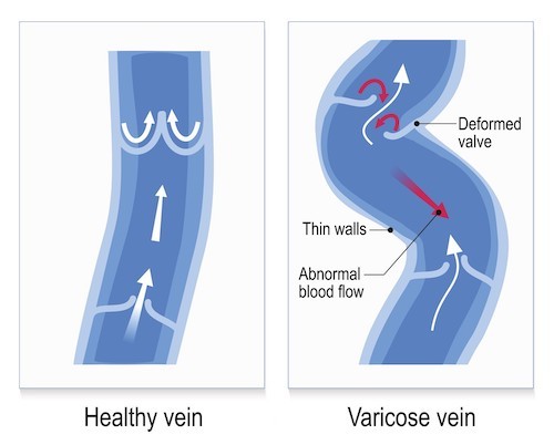 illustration unhealthy vein valves leaky veins damage weak walls flaps
