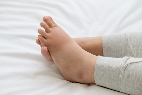 swollen ankles from leaky veins varicose veins palm desert