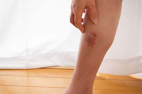 varicose eczema inflammation leg pain and development of open sores